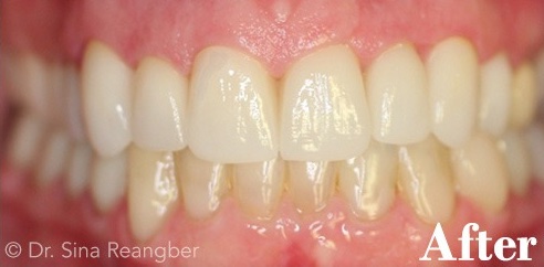 Porcelain Crowns 9 after
