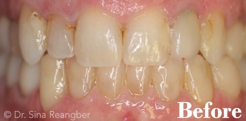 Porcelain Crowns 9 after