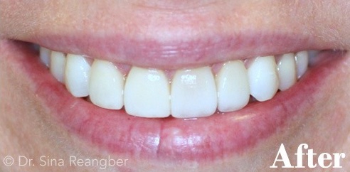 Porcelain Crowns and Veneers 1 after