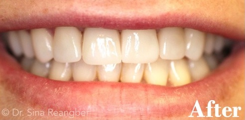 Porcelain Crowns and Veneers 2 after