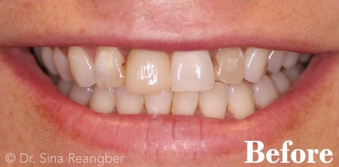 Porcelain Crowns and Veneers 2 before