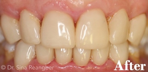 Porcelain Crowns on Lower Teeth to Match Upper Teeth after