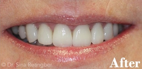 Porcelain Veneers 2 After