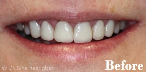 Porcelain Veneers 2 Before
