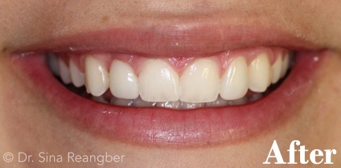 Porcelain Veneers 3 After