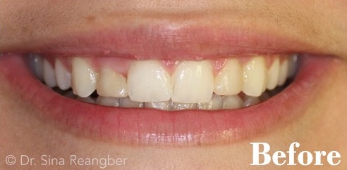 Porcelain Veneers 3 Before