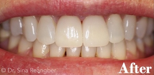 Porcelain Veneers 4 After