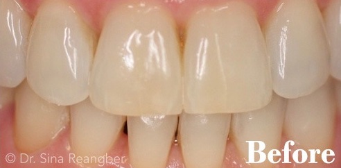 Porcelain Veneers 4 Before