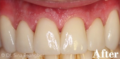 Porcelain Veneers 5 After