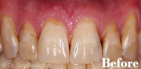 Porcelain Veneers 5 Before