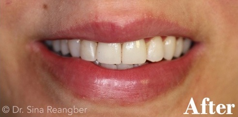 Porcelain Veneers 1 after