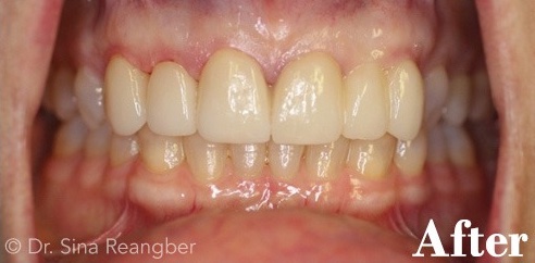 Porcelain Veneers and Crowns 2 after