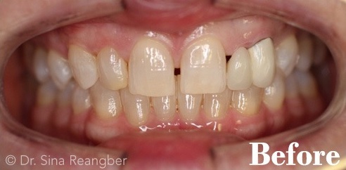 Porcelain Veneers and Crowns 2 before