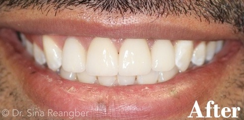 Porcelain Veneers and Crowns 3 after