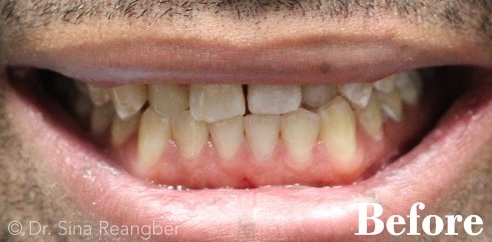 Porcelain Veneers and Crowns 3 before