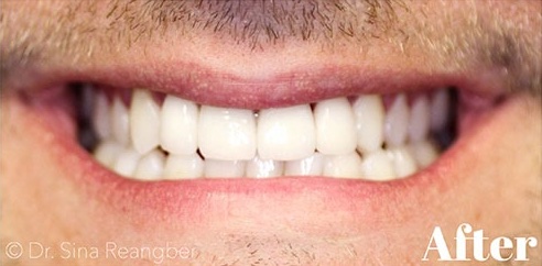 Porcelain Veneers and Crowns 4 after