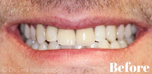 Porcelain Veneers and Crowns 4 before
