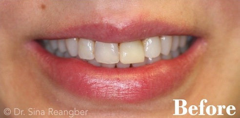 Porcelain Veneers 1 before