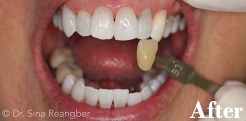 Tetracycline Stained Teeth Whitening After