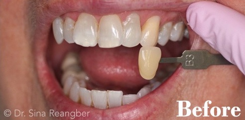 Tetracycline Stained Teeth Whitening Before