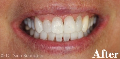 Tetracycline Stained Teeth Whitening 2 After