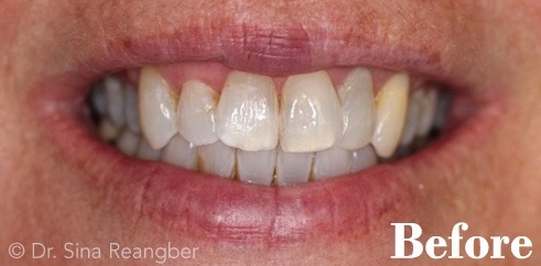 Tetracycline Stained Teeth Whitening 2 Before