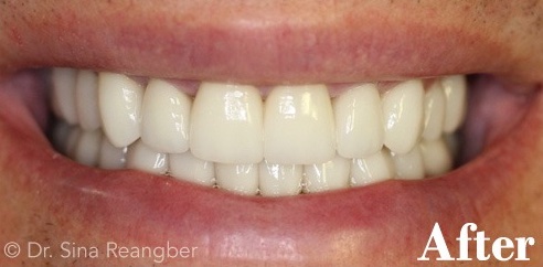 Porcelain Veneers 6 After
