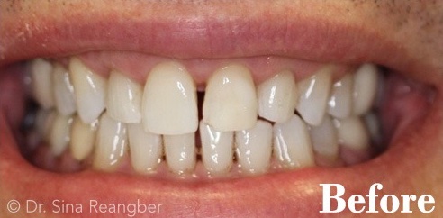 Porcelain Veneers 6 Before