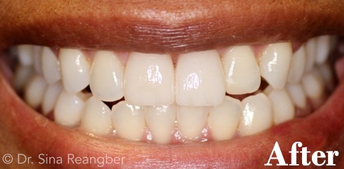 Whitening and Porcelain Crowns After