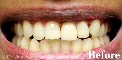 Whitening and Porcelain Crowns Before