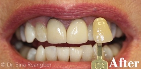 Whitening Tetracycline Stained After