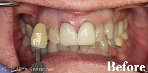 Whitening Tetracycline Stained Before