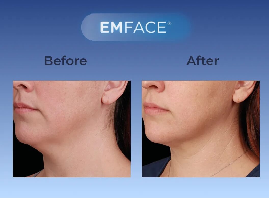 Facial Rejuvenation Testimonial 1