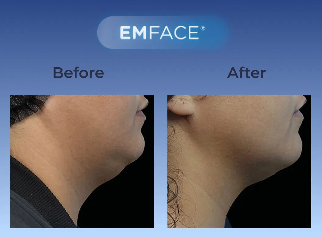 Facial Rejuvenation Testimonial 2