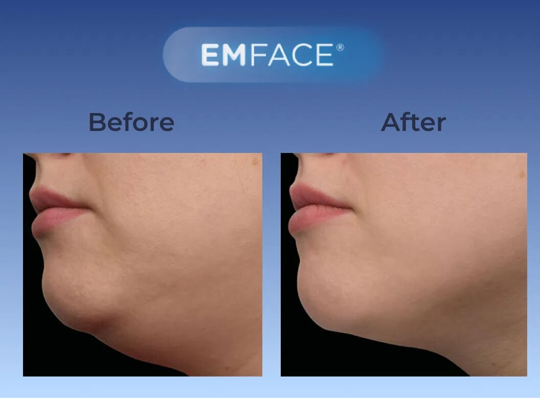 Facial Rejuvenation Testimonial 3