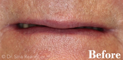 Implant crowns before