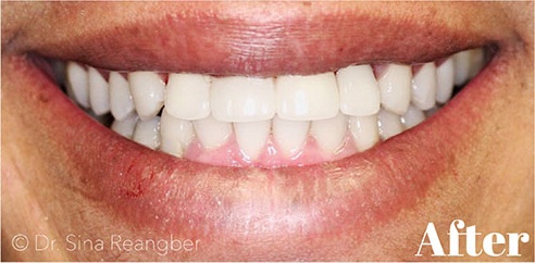 Implant supported bridge after