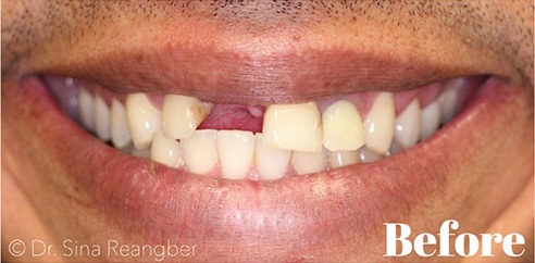 Implant supported bridge before