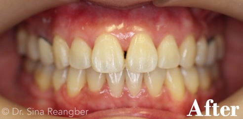 Invisalign after