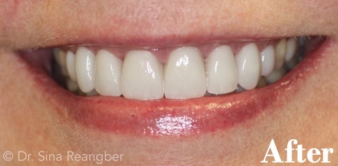 Veneers after