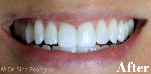 Veneers after