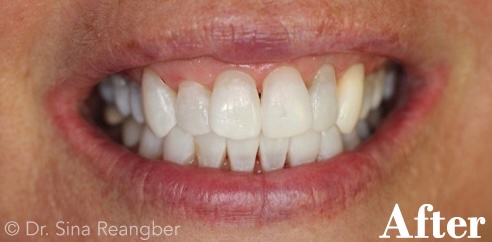 Whitening after