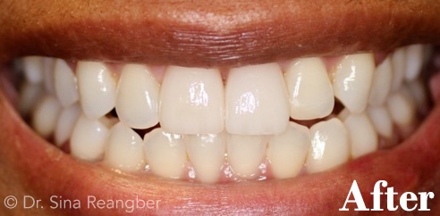 Whitening after