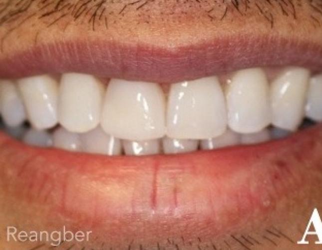 Bonding on Front Left Tooth After