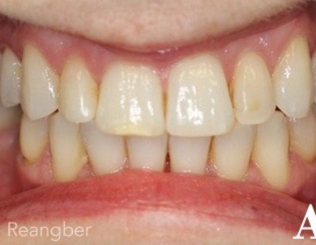Bonding on Front Left Tooth and Minor Invisalign Treatment after