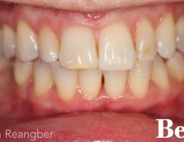 Bonding on Front Left Tooth and Minor Invisalign Treatment before