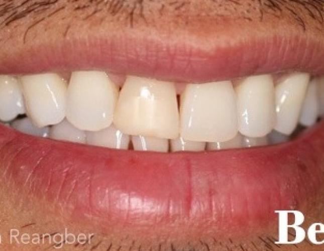 Bonding on Front Left Tooth Before
