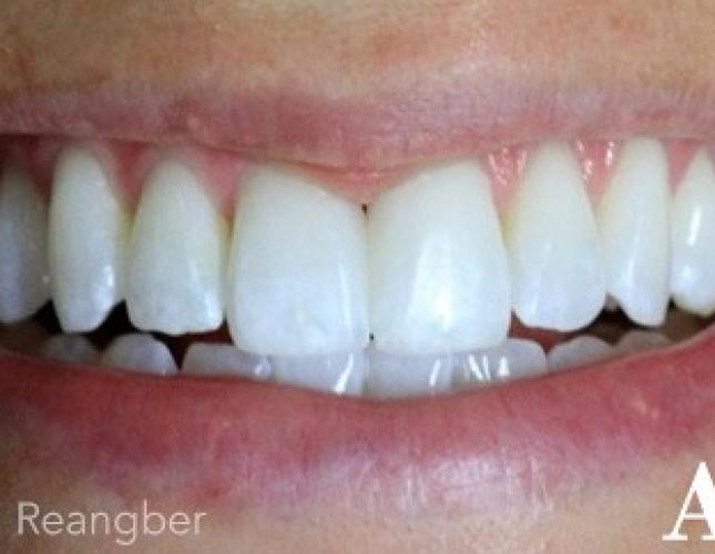 Bonding to Close Dark Space Between Two Front Teeth After
