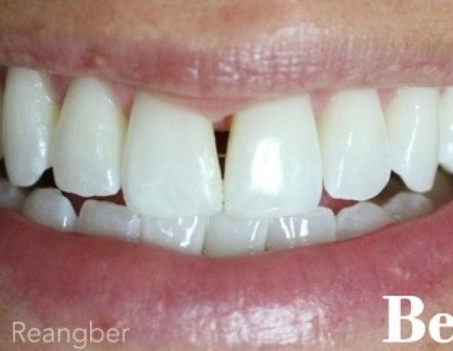 Bonding to Close Dark Space Between Two Front Teeth before