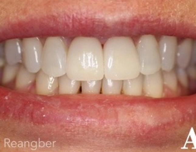 Cosmetic Bonding After